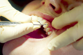 五反野駅・木村歯科医院・スケーリング