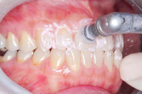 五反野駅・木村歯科医院・PMTC