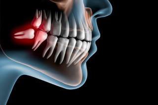五反野駅・木村歯科医院・親知らず