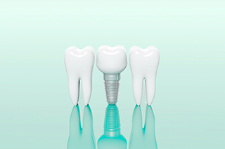 五反野駅・木村歯科医院・インプラント